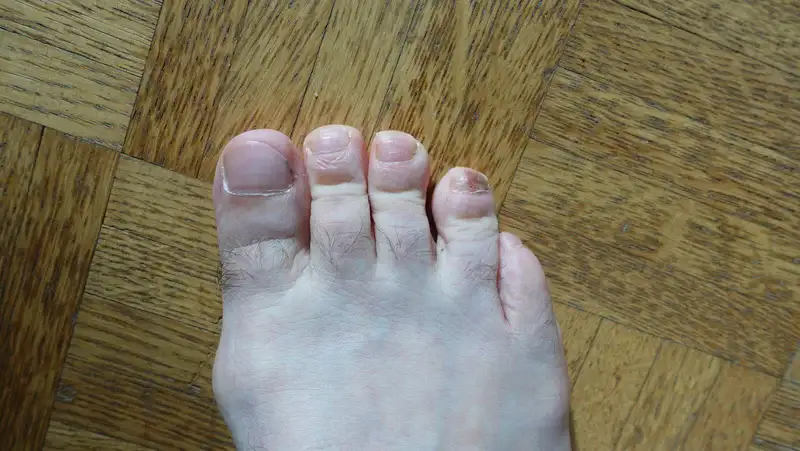 My bruised toenails.